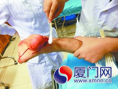 脚底一滑跟腱断裂