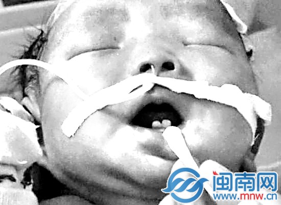 初生女婴长两门牙 疑因孕妇过量补钙