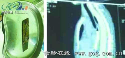 女孩和男朋友闹矛盾，一气之下吞下裁纸刀