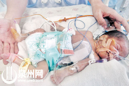 手术成功的“先心病宝宝”，在医护人员手中显得非常