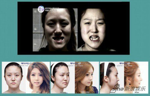 韩国戽斗脸双胞胎姐妹数次整形 两人长相仍相