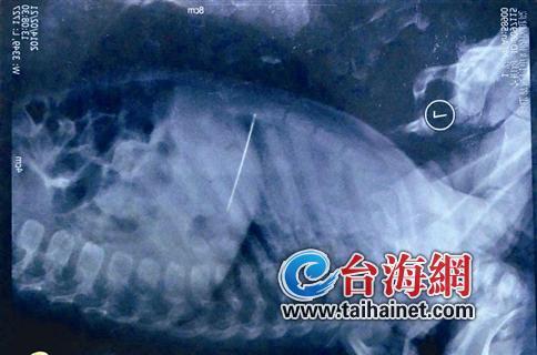 5厘米长缝衣针扎入厦门一孩童内脏 医生称取针有难度大