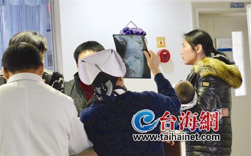 5厘米长缝衣针扎入厦门一孩童内脏 医生称取针有难度大