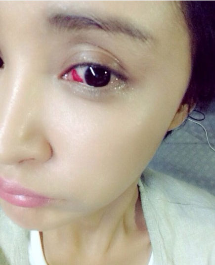 张歆艺眼底出血坚持工作:还不如流鼻血