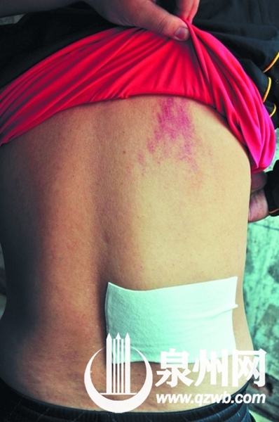 黄先生背部还有明显的伤痕