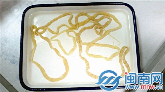 李女士排出的整条绦虫,长约2.5米