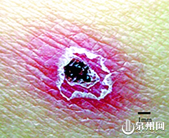 恙虫叮咬后症状伤口图片 提醒:夏季勿坐卧草丛-闽南网